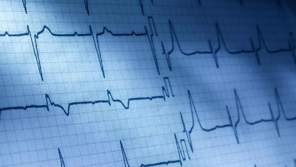 resultado de um teste de Eletrocardiograma 